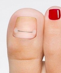 Установка титановой нити