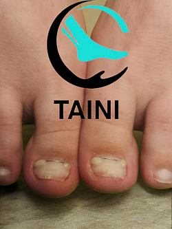 Установка титановой нити