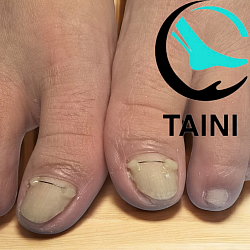 Установка и лечение титановой нитью