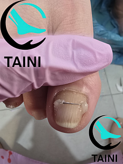 חוט טיטניום. Титановая нить