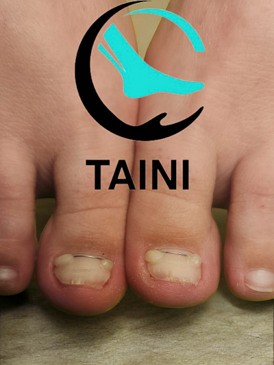 Выравнивание ногтевой пластины