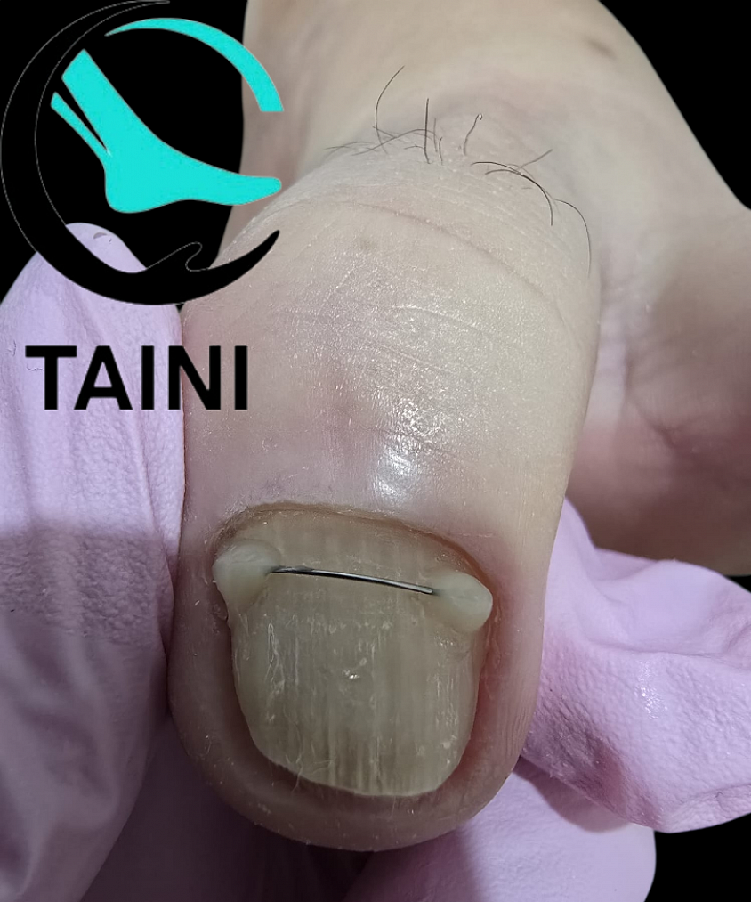 ​חוט טיטניום מותקן בצורה נכונה ומדויקת על הציפורן. דוגמה מתוך תרגול מעשי בקורס