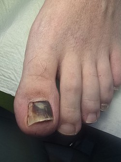 Удаление травмированной ногтевой пластины