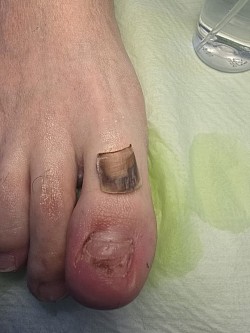 Удвление травмированной ногтевой пластины