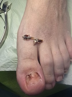 Удаление травмированной ногтевой пластины