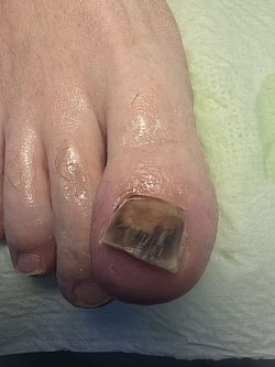 הסרת לוחית הציפורן הפגועה