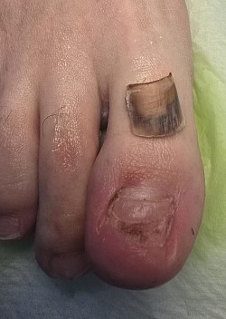 הסרת לוחית הציפורן הפגועה