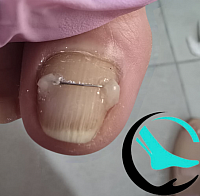 חוט טיטניום, טיפול בצלחת הציפורן