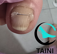 Установка титановой нити, лечение ногтевой пластины