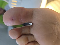 Удаление стержневой мазоли  הסרת יבלת ליבה