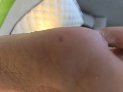 הסרת יבלת ליבה, удаление стержневой мазоли