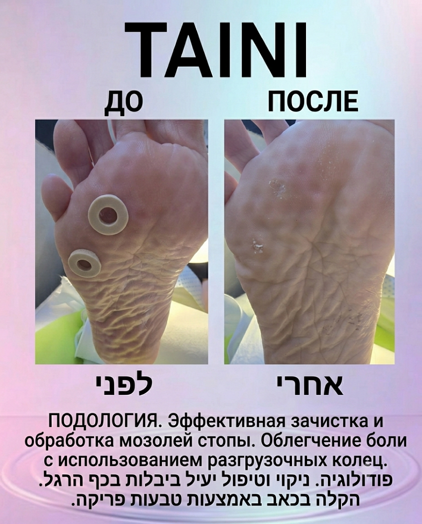 Удаление мозолей и разгрузка стопы в TAINI  Зачистка подошвенных мозолей и применение разгрузочных колец для снятия давления и боли. Результат — чистая, здоровая кожа и комфорт при ходьбе.  ניקוי יבלות דריכה ושימוש שטבעות פריקה להקלת הלחץ והכאב. התוצאה — עור נקי, בריא ונוחות מרבית בהליכה.