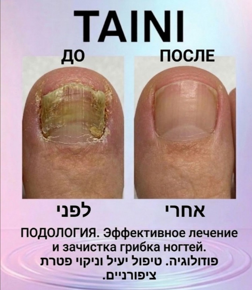Описание на русском: ​Фотография представляет собой коллаж «До и После» результатов лечения грибка ногтей (онихомикоза) в клинике TAINI. ​Слева (До): Показан запущенный случай грибковой инфекции большого пальца стопы. Ногтевая пластина сильно утолщена, деформирована, имеет болезненный желто-коричневый оттенок и крошащуюся текстуру. Кожа вокруг ногтя выглядит воспаленной. ​Справа (После): Результат профессиональной подологической зачистки и лечения. На месте пораженного ногтя теперь находится чистая, гладкая и здоровая пластина (или ее протез). Кожа вокруг выглядит восстановленной и здоровой. ​תיאור בעברית: ​התמונה מציגה קולאז' 