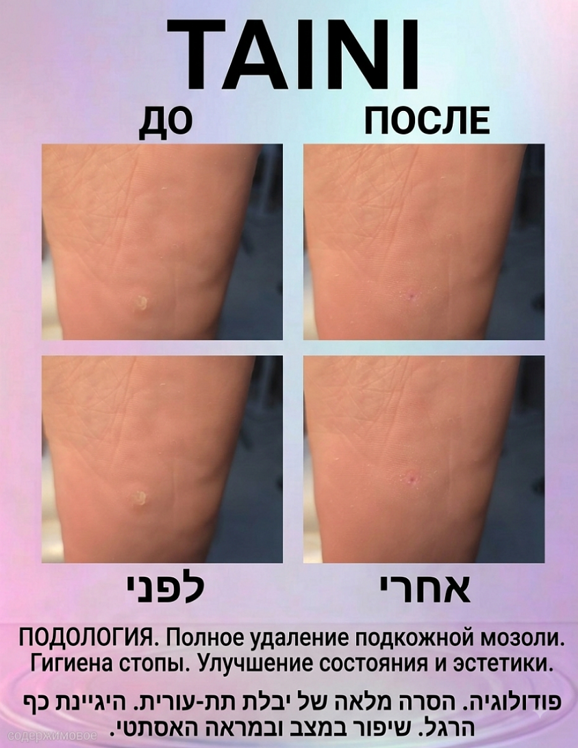 ​ПОДОЛОГИЯ. Удаление стержневой (подкожной) мозоли. До: Локальный гиперкератоз с глубоким роговым стержнем, вызывающий боль при ходьбе. После: Полное удаление стержня, снятие болевого синдрома и восстановление кожи. ​פודולוגיה. הסרת יבלת מסמר (תת-עורית). לפני: התקשות עור מקומית עם ליבה עמוקה הגורמת לכאב בהליכה. אחרי: הסרה מלאה של הליבה, החרדה מיידית של הכאב ושקום העור.