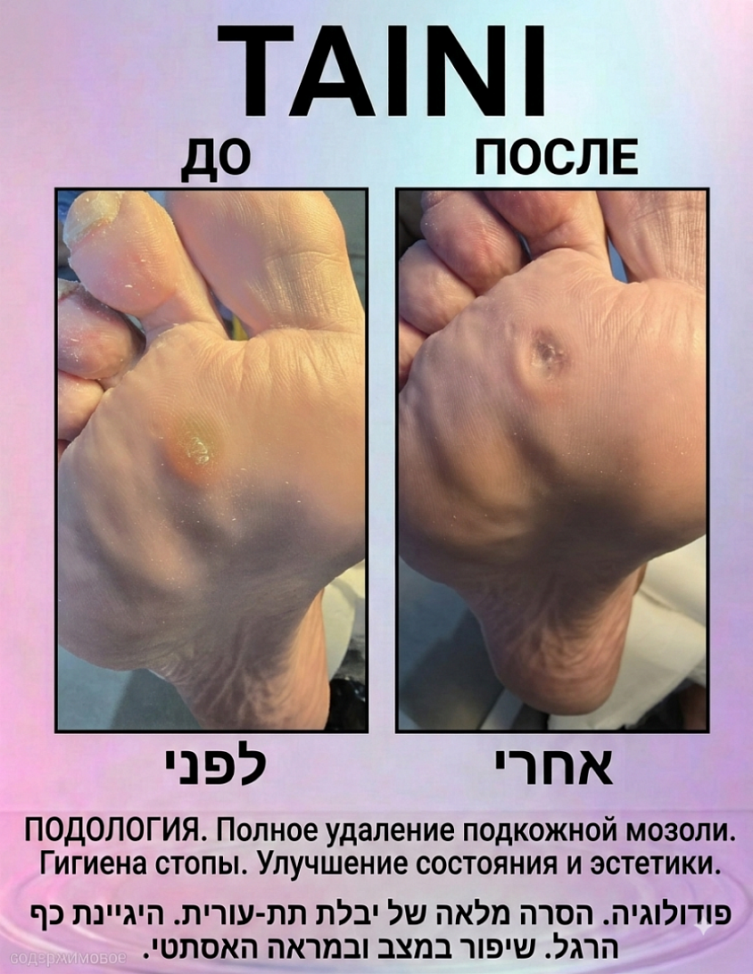 הסרת יבלת שורש: תוצאה בפגישה אחת ​דוגמה למקצועיות ודיוק במרכז TAINI: יבלת תת-עורית עמוקה הוסרה במלואה, הלחץ והכאב בזמן הליכה נעלמו, ועור כף הרגל חזר למראה בריא ואסתטי. ​התוצאה: הקלה מיידית, ללא כאבים וללא זמן החלמה. ​השירות: פודולוגיה מקצועית, היגיינת כף הרגל וטיפול אסתטי.