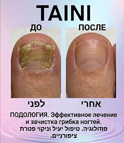 תוצאת טיפול בפטרת ציפורניים במרכז הפודיאטריה TAINI: תמונות לפני ואחרי ניקוי לוחית הציפורן.