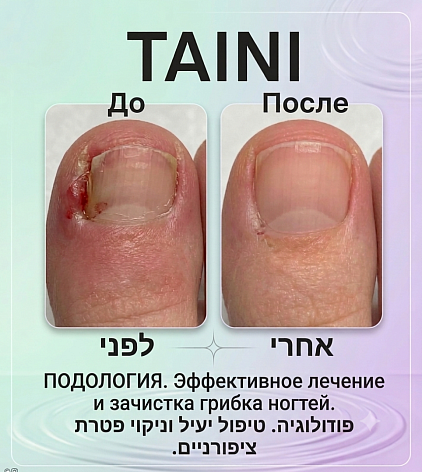 ​ציפורן חודרנית, טיפול בציפורן חודרנית, הסרת פינות חודרניות, ניקוי ציפורן חודרנית, מיתר טיטניום, לפני ואחרי, פודולוגיה, פודולוג פתח תקווה, TAINI, טאיני, פדיקור רפואי, טיפול ללא דימום, פתח תקווה