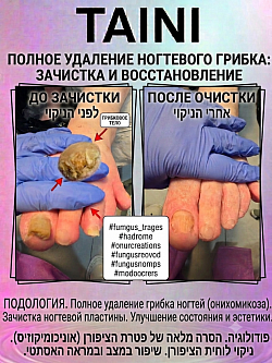 ПОДОЛОГИЯ. Полное удаление грибка ногтей (онихомикоза). Зачистка ногтевой пластины. Улучшение состояния и эстетики.  פודולוגיה. הסרה מלאה של פטרת הציפורן (אוניכומיקוזיס). ניקוי לוחית הציפורן. שיפור במצב ובמראה האסתטי.