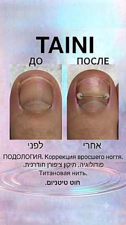 коррекция вросшего ногтя титановая нить.     תיקון ציפורן חודרנית בעזרת חוט טיטניום