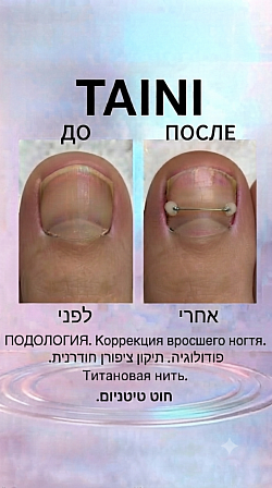 התקנה של חוט טיטניום